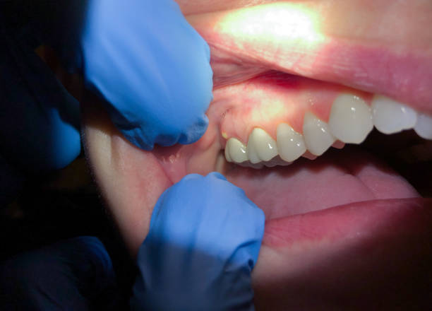 Best Emergency Root Canal Treatment in Long Branch, NJ
